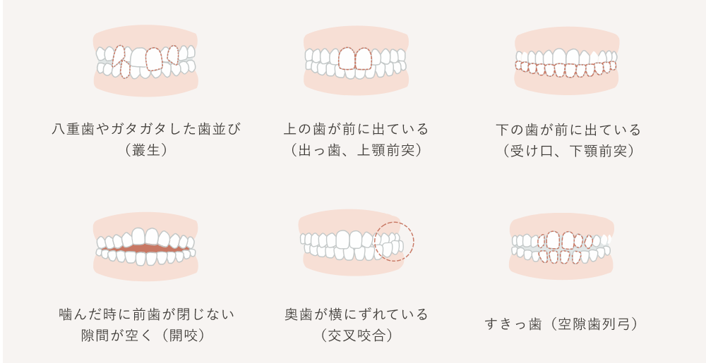 歯科矯正をした芸能人とは 治療で美しくなる人は何が違うのか 千葉県柏市で歯列矯正なら柏kt矯正歯科